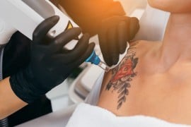 Come rimuovere un tatuaggio