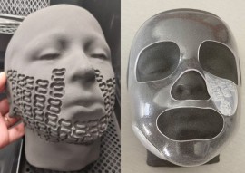 La stampa 3D per curare i bambini con ustioni gravi al viso