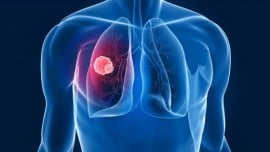 Tumore al polmone: ancora luci e ombre nell’accesso alle cure piú innovative in Italia